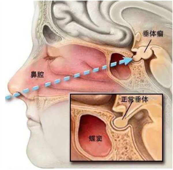不开颅,鼻孔里面“夹出”肿瘤1857.png 不开颅,鼻孔里面“夹出”肿瘤1857.png