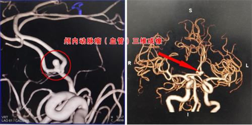 手术接力!栓塞引流“无缝衔接”540.png