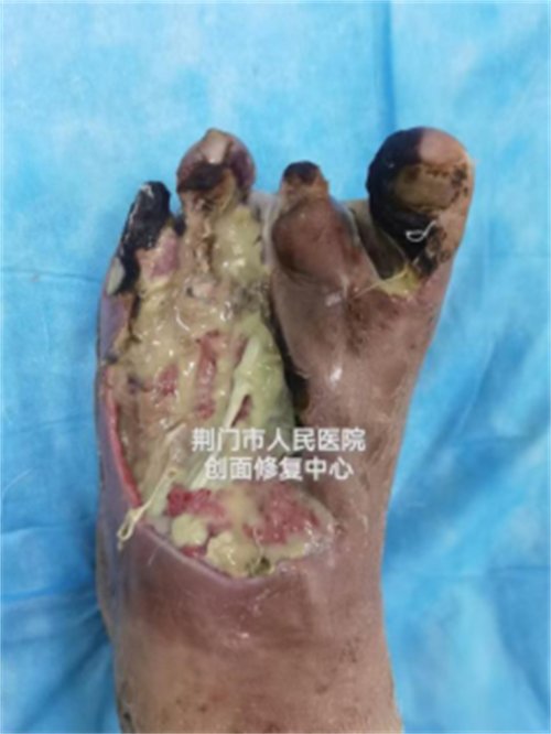迎难而上，力保“糖足”不失！2145.png