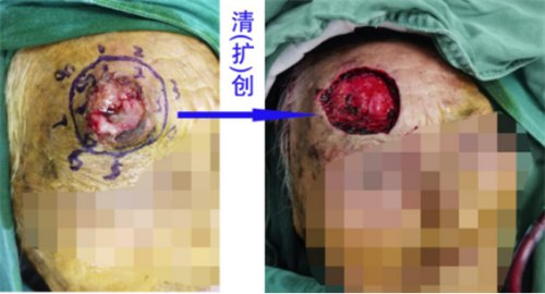 前额溃烂“巧修补” 百岁老人“焕新颜”1287.png 前额溃烂“巧修补” 百岁老人“焕新颜”1287.png