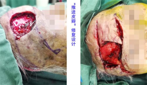 前额溃烂“巧修补” 百岁老人“焕新颜”1305.png 前额溃烂“巧修补” 百岁老人“焕新颜”1305.png