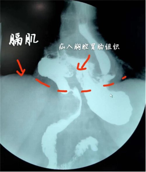 微创除“疝”,让“串门”的胃“回家”2086.png 微创除“疝”,让“串门”的胃“回家”2086.png