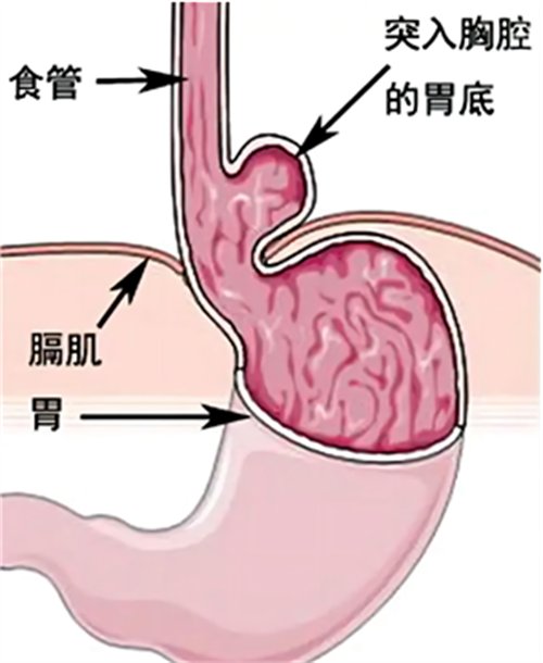 微创除“疝”,让“串门”的胃“回家”2068.png 微创除“疝”,让“串门”的胃“回家”2068.png