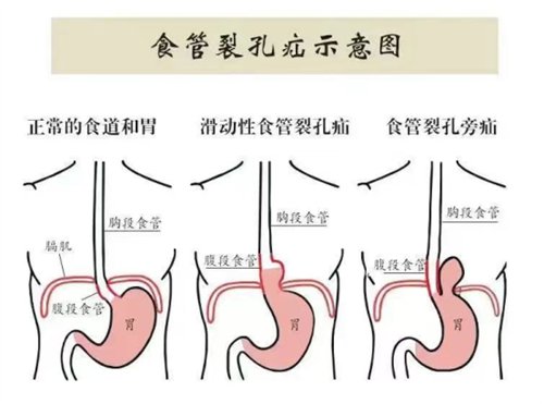 微创除“疝”,让“串门”的胃“回家”2080.png 微创除“疝”,让“串门”的胃“回家”2080.png
