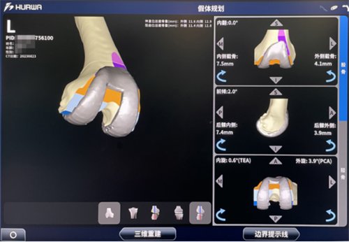 全市首例!“机器人”辅助换关节(1)1555.png