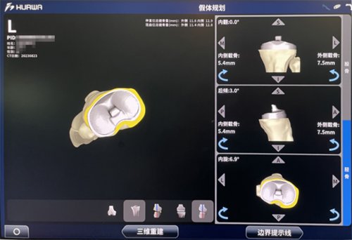 全市首例!“机器人”辅助换关节(1)1557.png