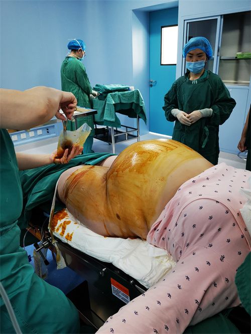 佘小艳为体重135公斤孕妈妈行剖宫产术.jpg 佘小艳为体重135公斤孕妈妈行剖宫产术.jpg