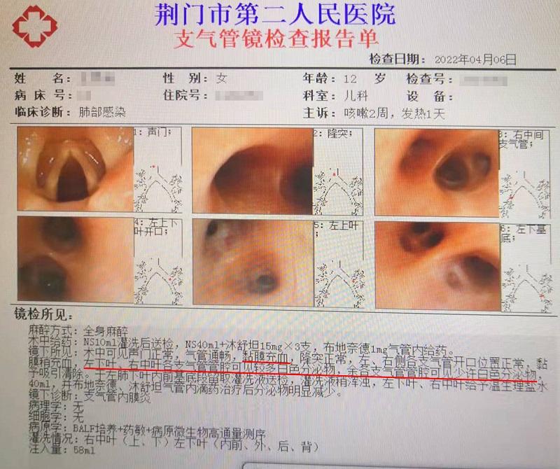 电子支气管镜检查、治疗、取样送检“一举多得”.jpg 电子支气管镜检查、治疗、取样送检“一举多得”.jpg