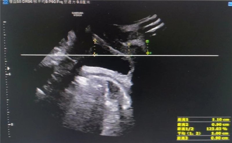 子宫脱垂影像(资料图).png 子宫脱垂影像(资料图).png