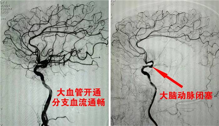 术前术后血管造影对比1.jpg 术前术后血管造影对比1.jpg