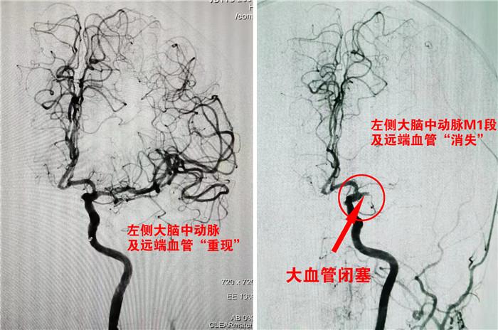 术前术后血管造影对比.jpg 术前术后血管造影对比.jpg