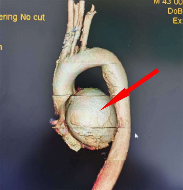 血管三维成像(红箭头所指为巨大“主动脉瘤”).png 血管三维成像(红箭头所指为巨大“主动脉瘤”).png