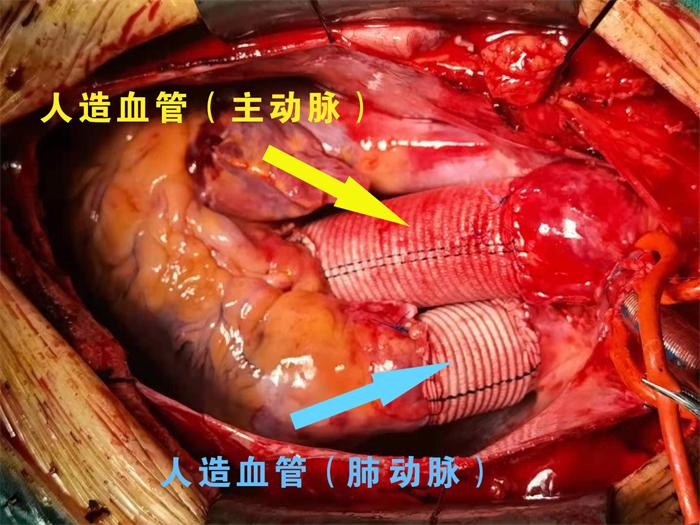 人造血管成功置换、吻合.png 人造血管成功置换、吻合.png