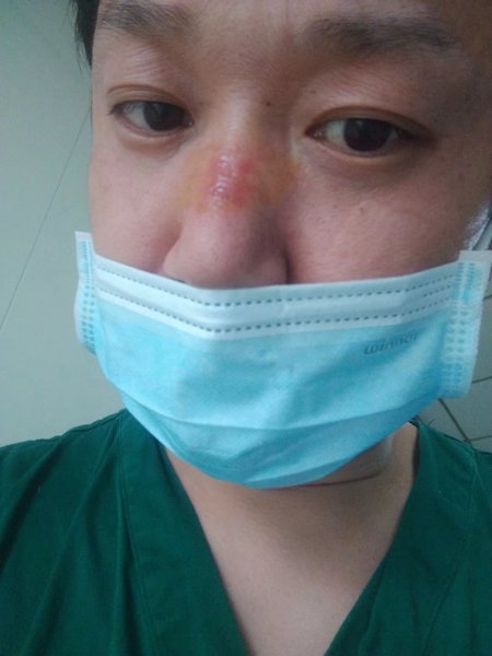 长时间戴口罩,任进一的鼻子出现了压疮_副本.jpg 长时间戴口罩,任进一的鼻子出现了压疮_副本.jpg