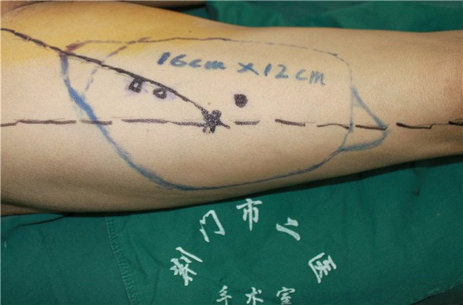 大腿外侧取皮处.jpg 大腿外侧取皮处.jpg