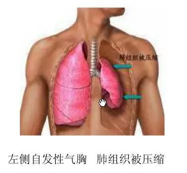自发性气胸惹上“小鲜肉”,你需要注意这些