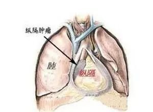 纵膈肿瘤患者健康教育